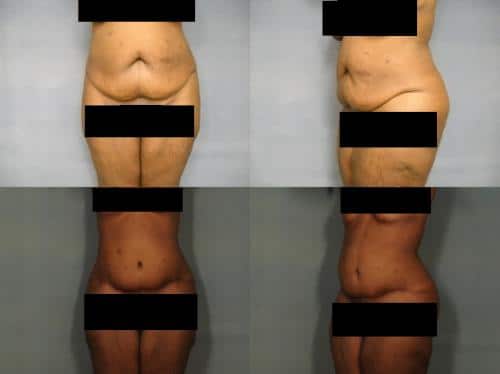 Tummy Tuck Case #841 Combined Image