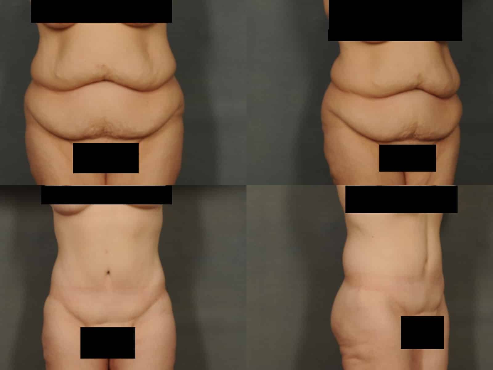 Tummy Tuck Case# 841 Combined Image