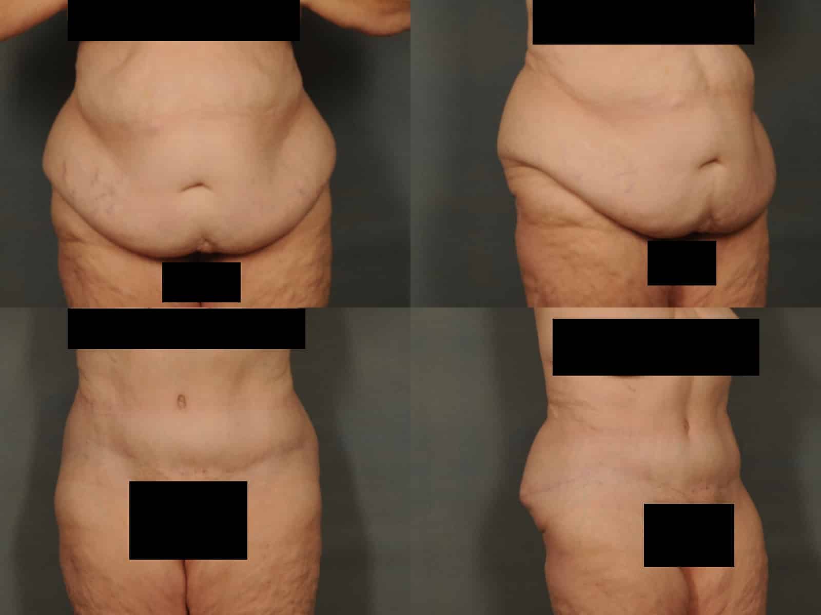 Tummy Tuck Case# 847 Combined Image