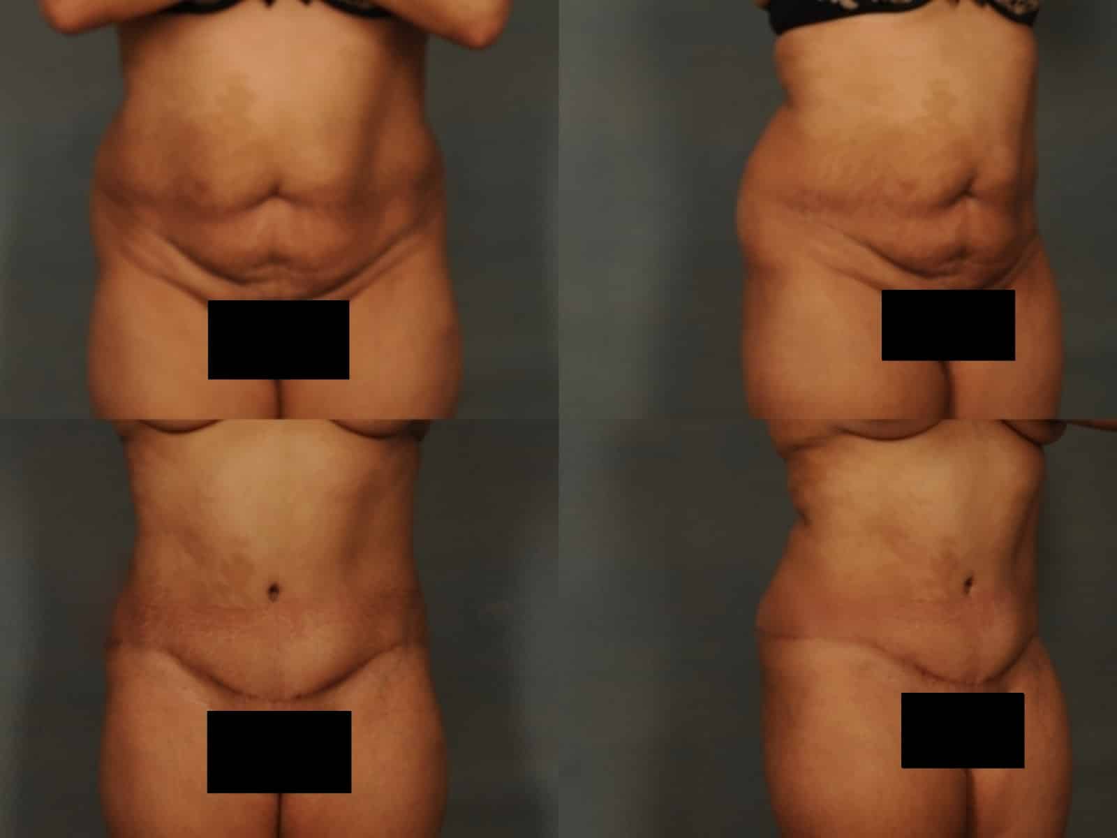 Tummy Tuck Case# 850 Combined Image