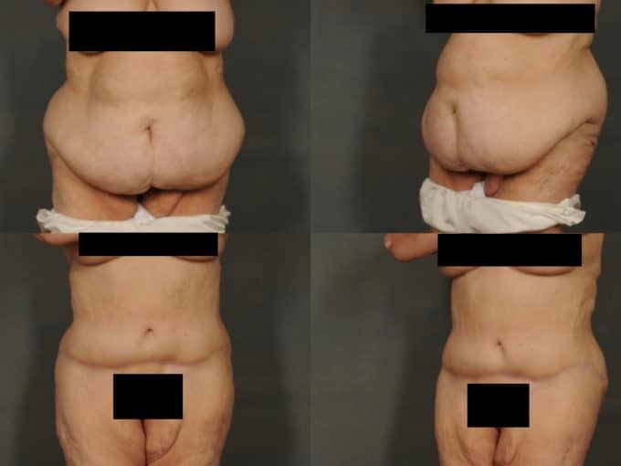Tummy Tuck Case# 851 Combined Image