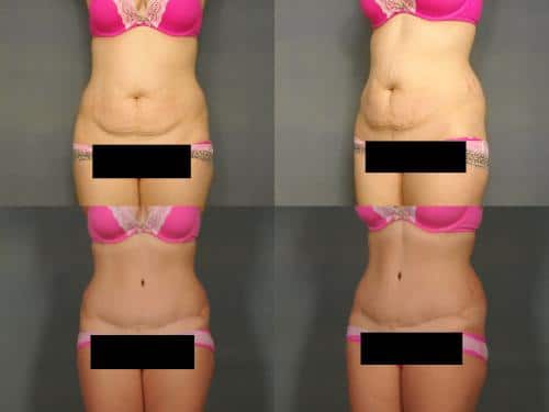 Tummy Tuck Case #861 Combined Image