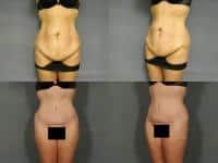 Tummy Tuck Case #871 Combined Image