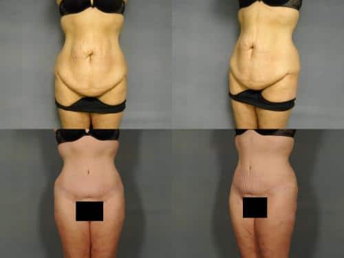 Tummy Tuck Case #871 Combined Image