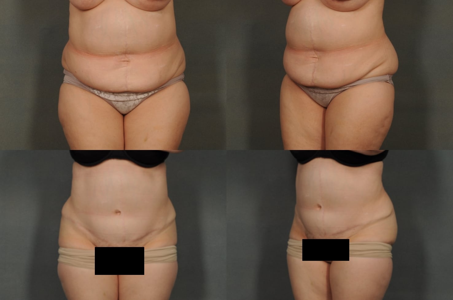 Tummy Tuck Case# 871 Combined Image
