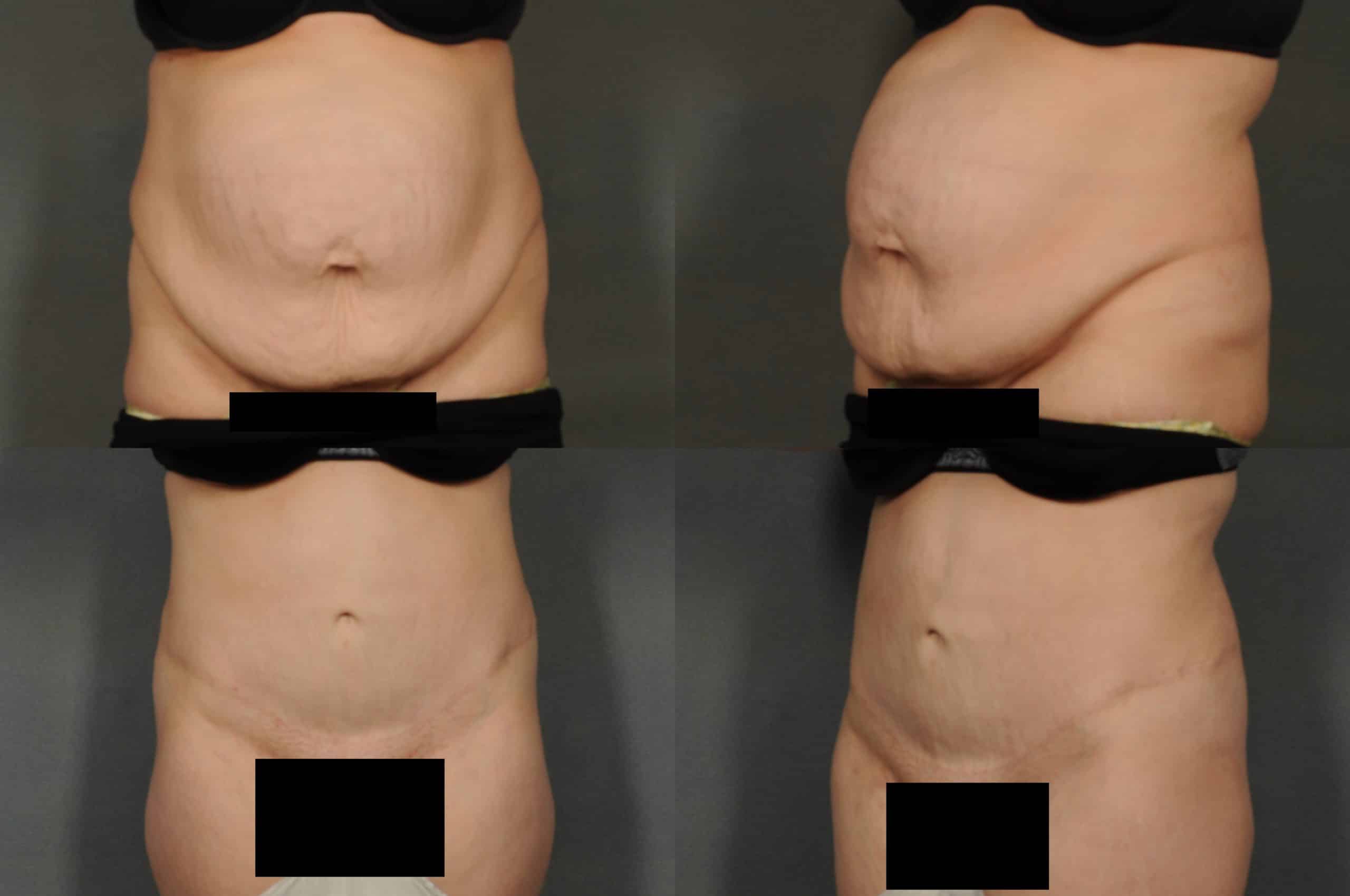 Tummy Tuck Case# 878 Combined Image