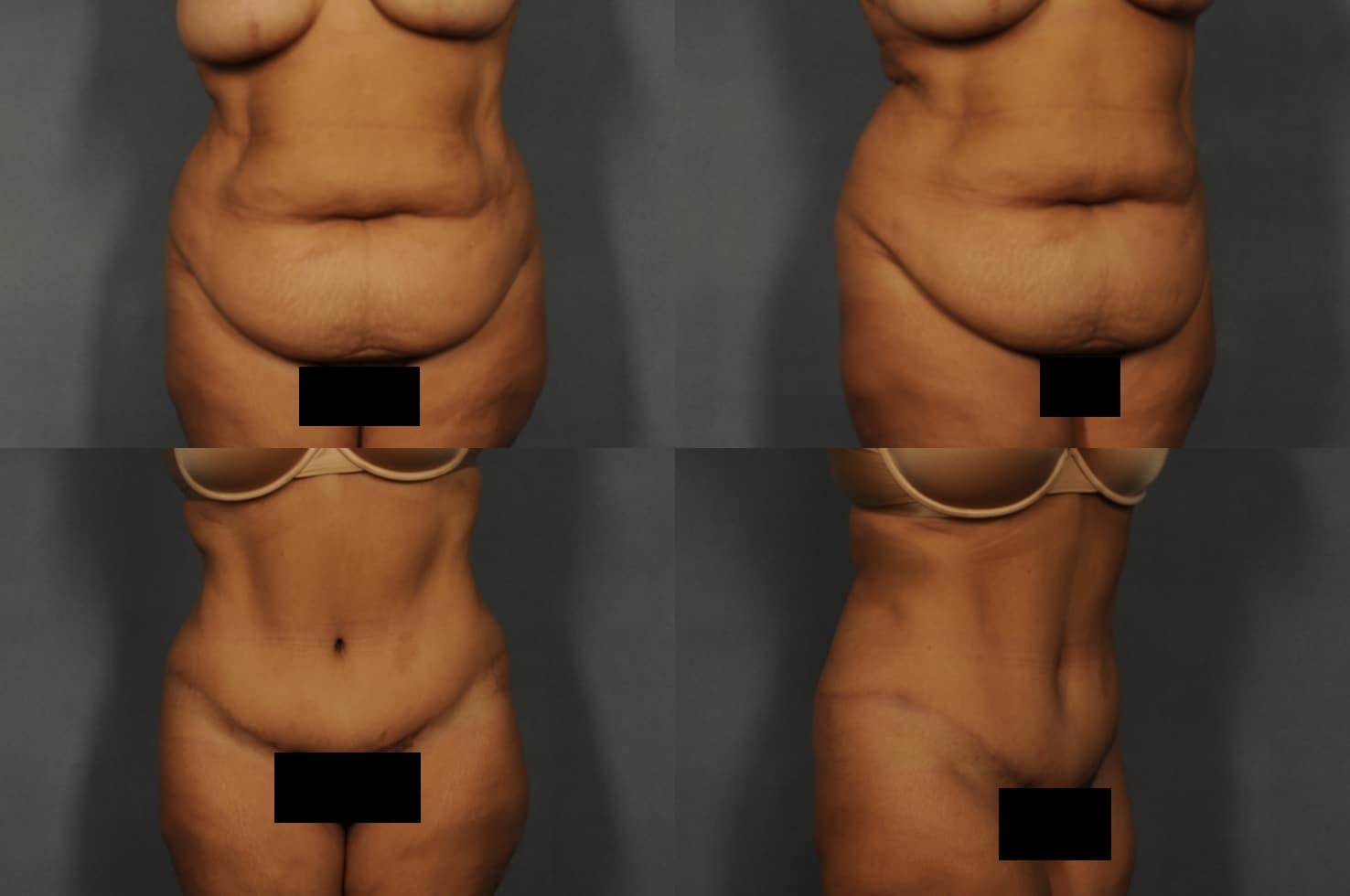 Tummy Tuck Case# 882 Combined Image