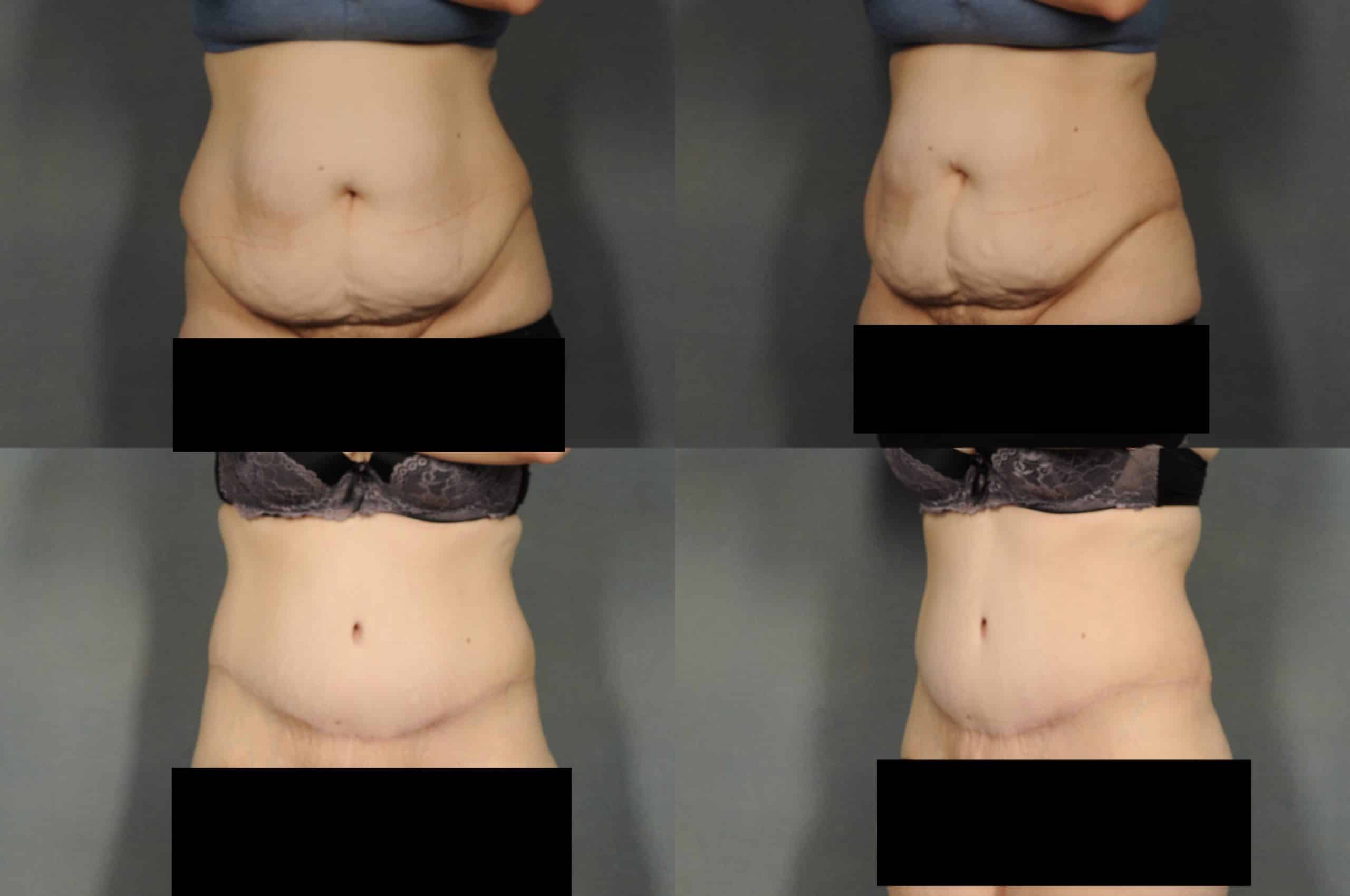 Tummy Tuck Case# 883 Combined Image