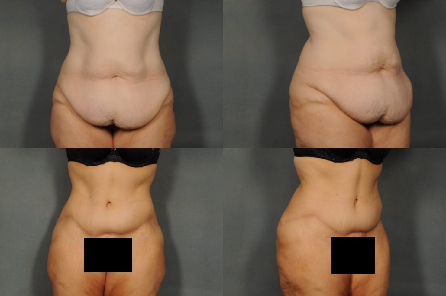 Tummy Tuck Case# 884 Combined Image