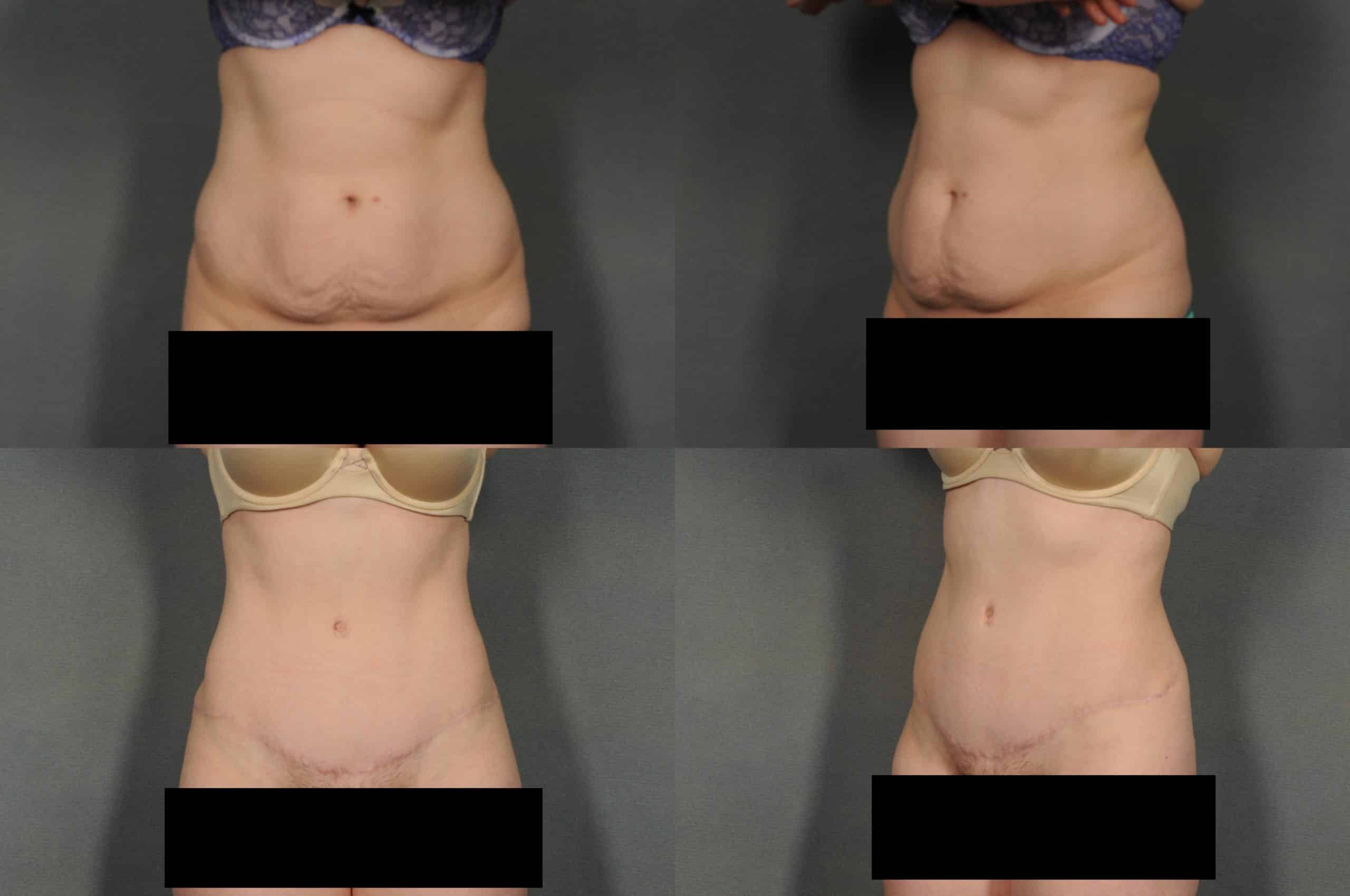 Tummy Tuck Case# 885 Combined Image
