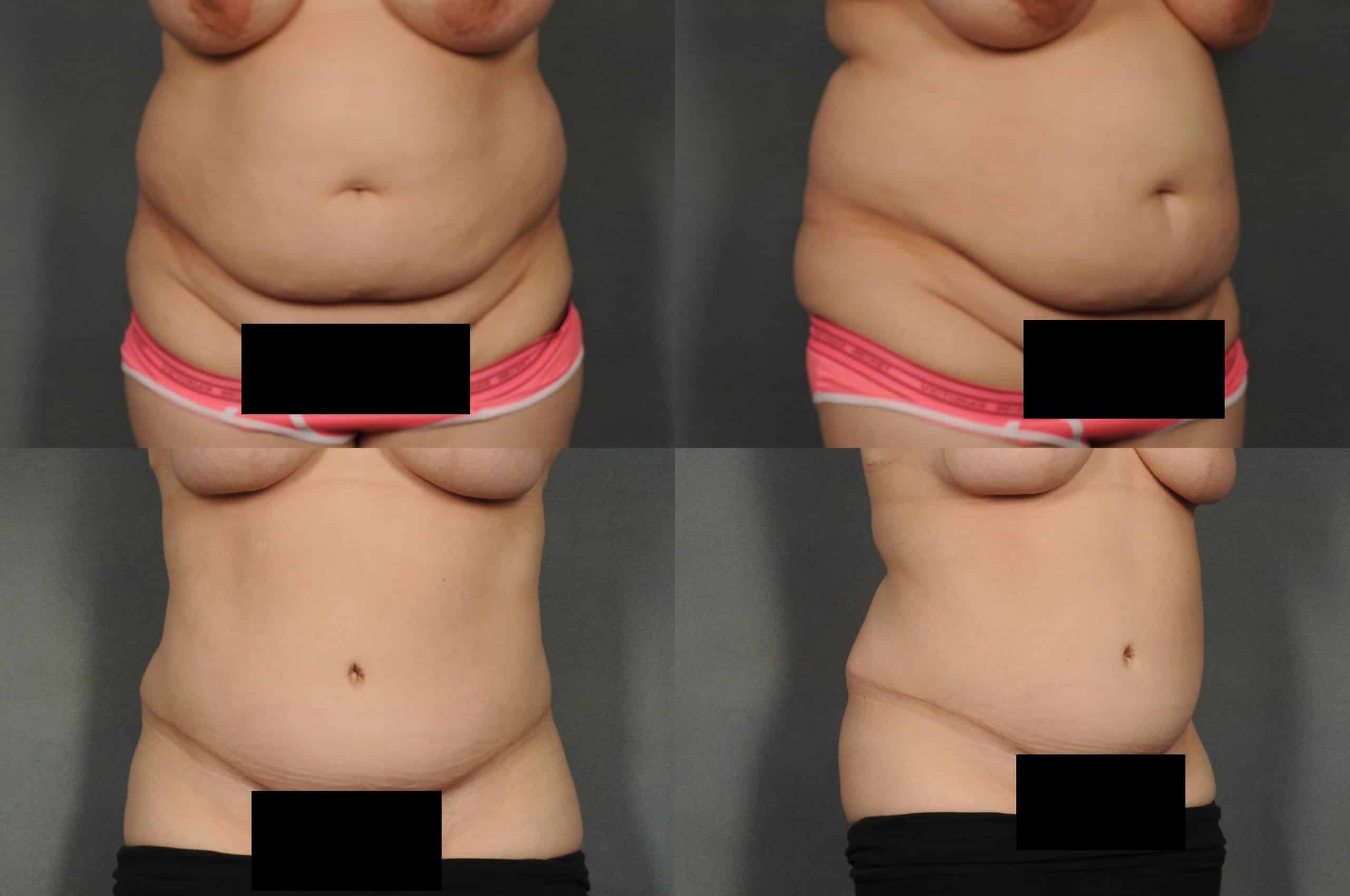 Tummy Tuck Case# 890 Combined Image
