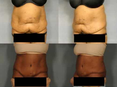 Tummy Tuck Case #891 Combined Image