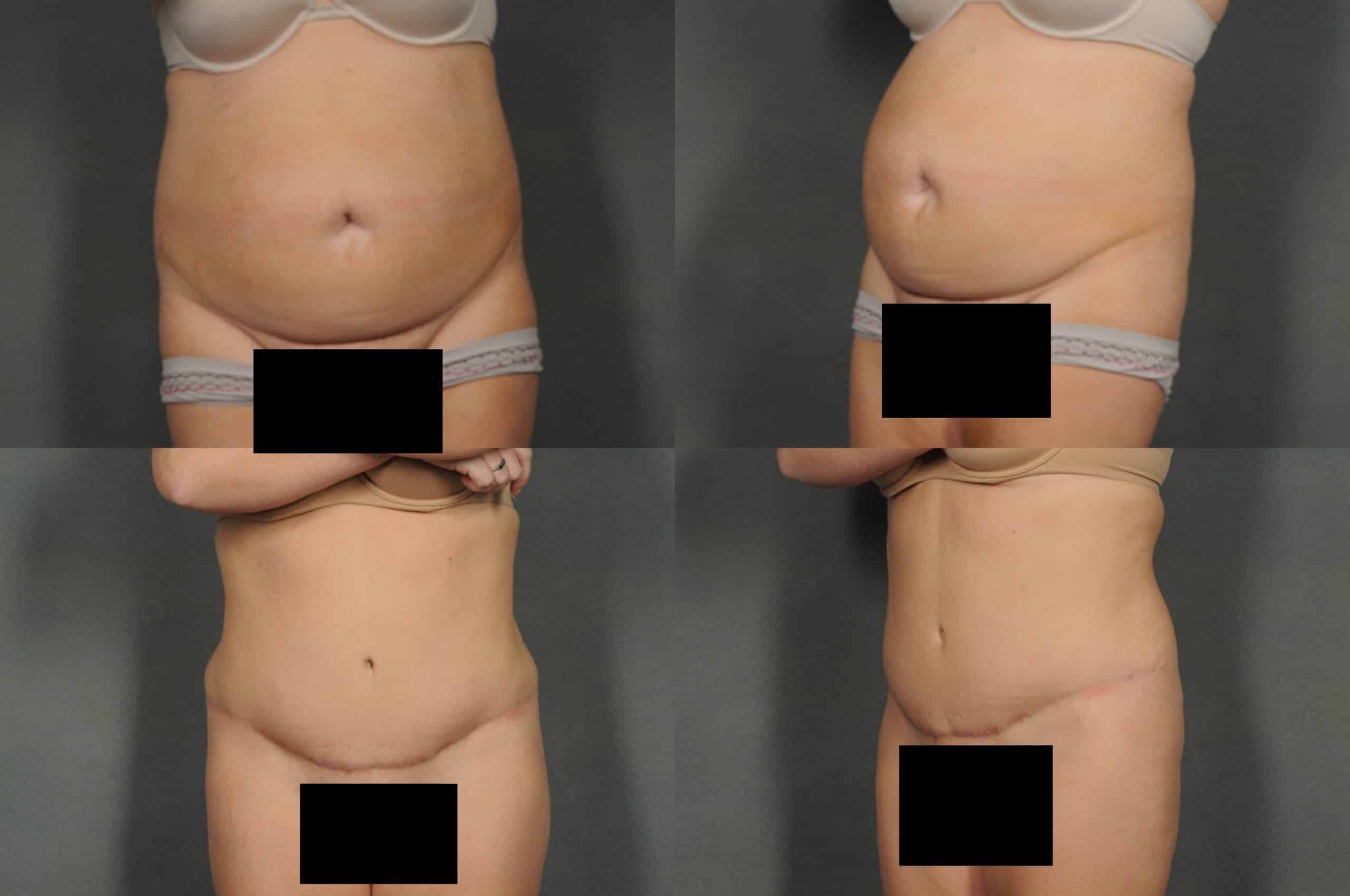 Tummy Tuck Case# 895 Combined Image
