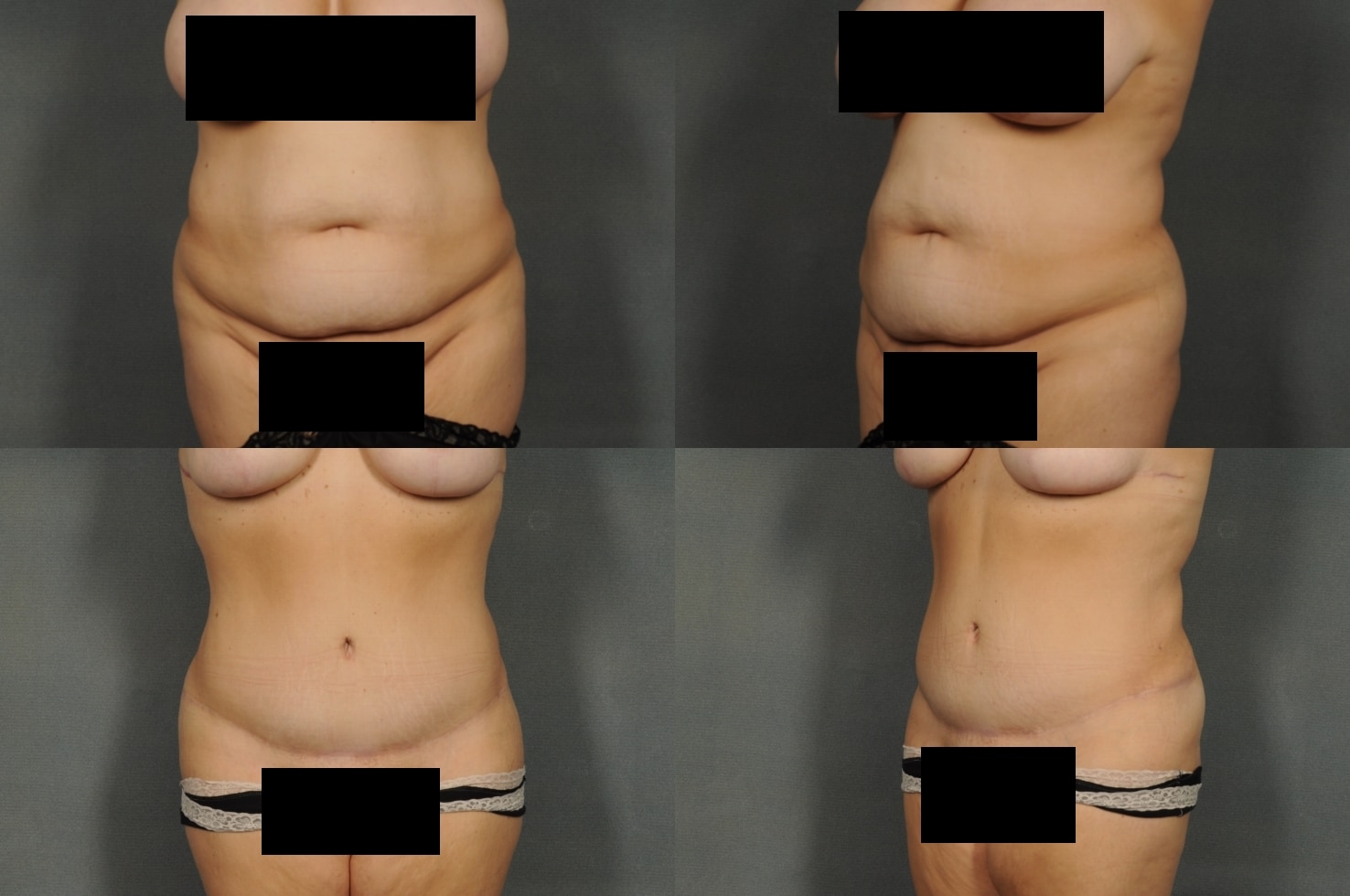 Tummy Tuck Case# 897 Combined Image