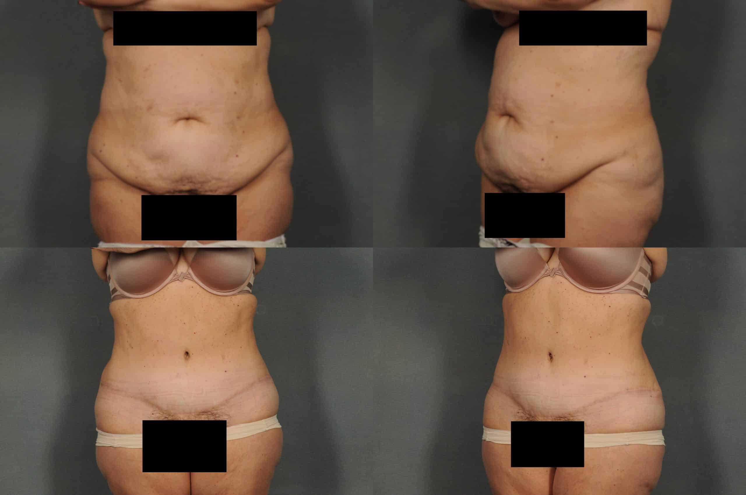 Tummy Tuck Case# 898 Combined Image