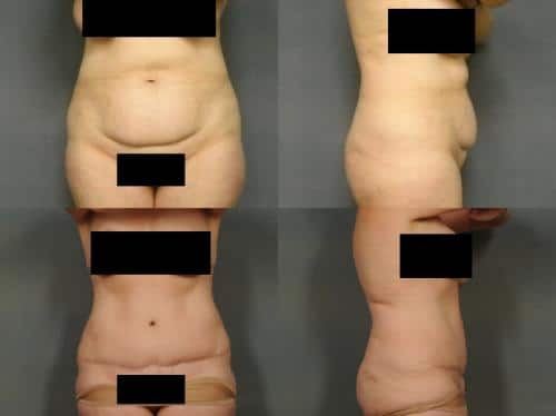 Tummy Tuck Case #901 Combined Image