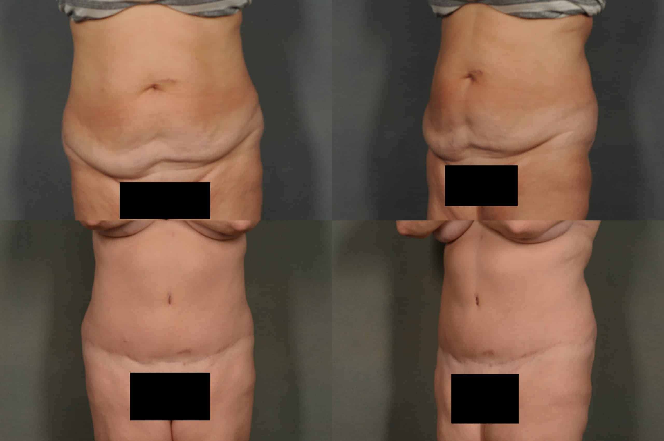 Tummy Tuck Case# 904 Combined Image