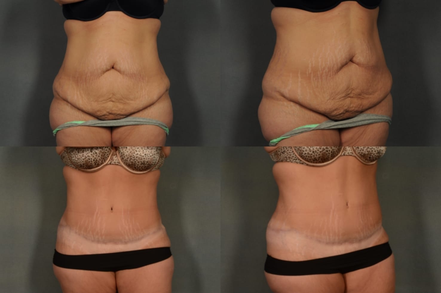 Tummy Tuck Case# 906 Combined Image