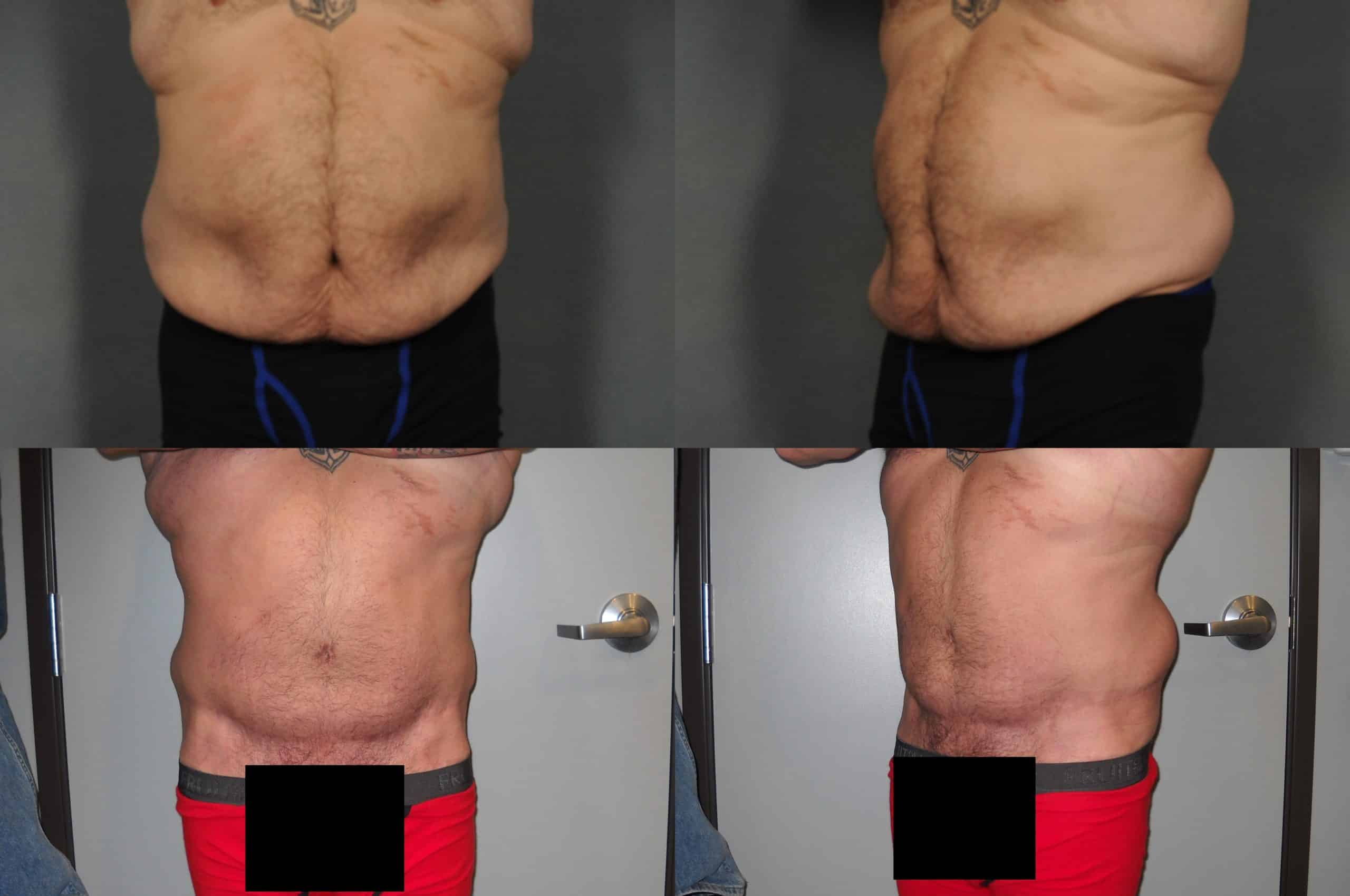 Tummy Tuck Case# 907 Combined Image