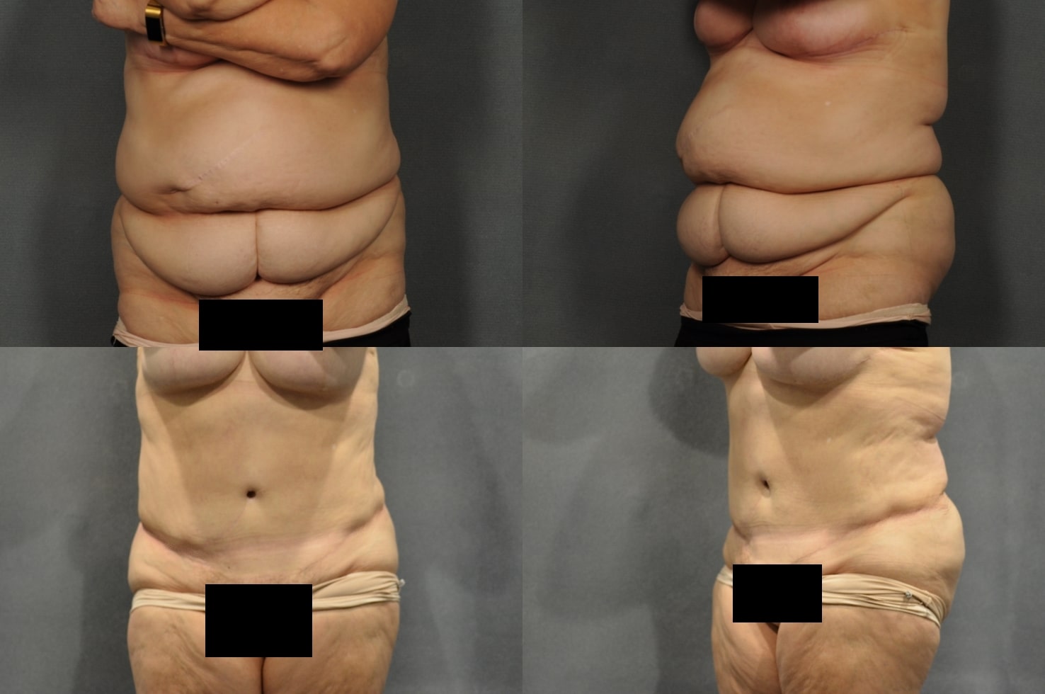 Tummy Tuck Case# 909 Combined Image