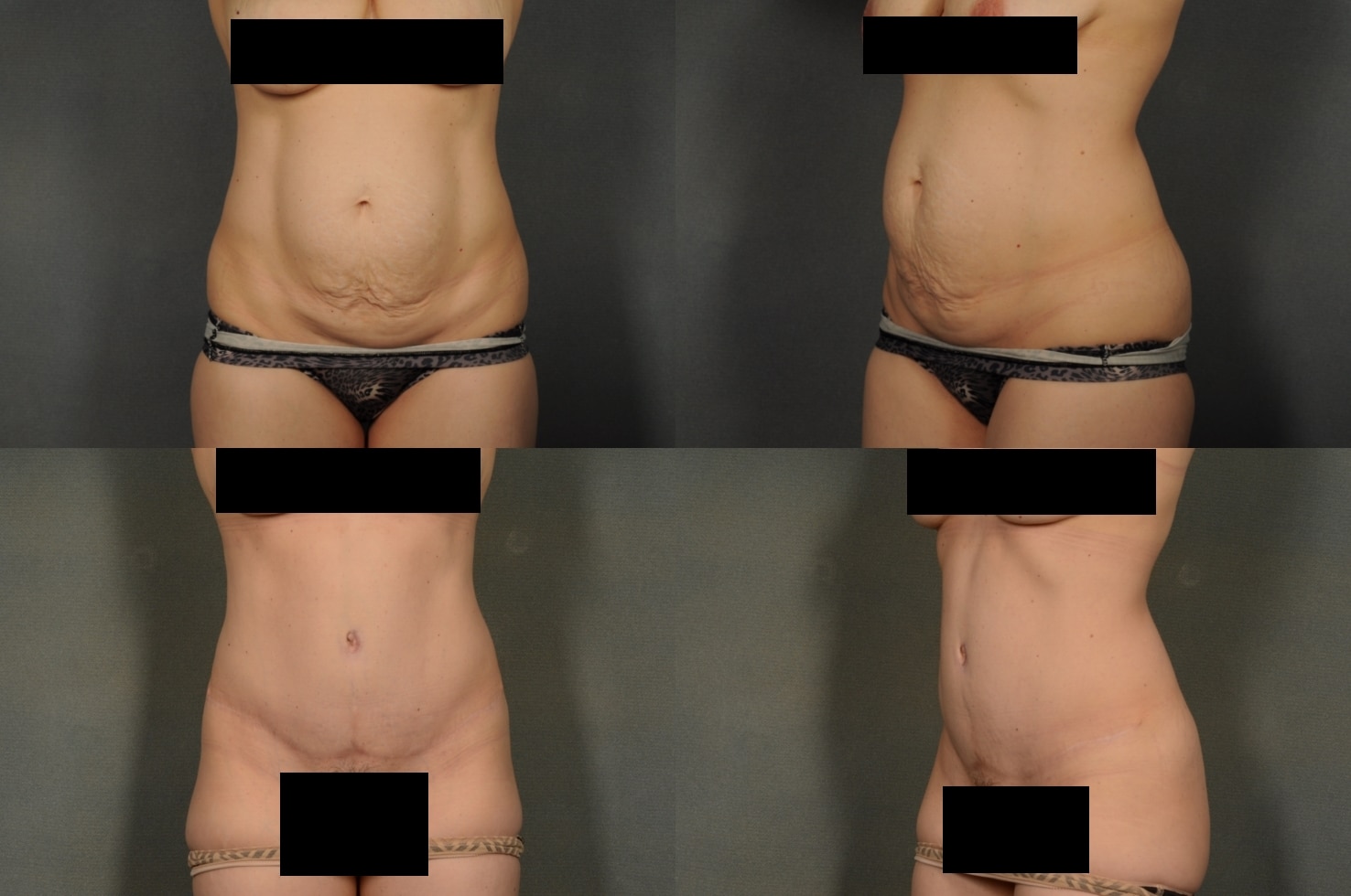 Tummy Tuck Case# 912 Combined Image