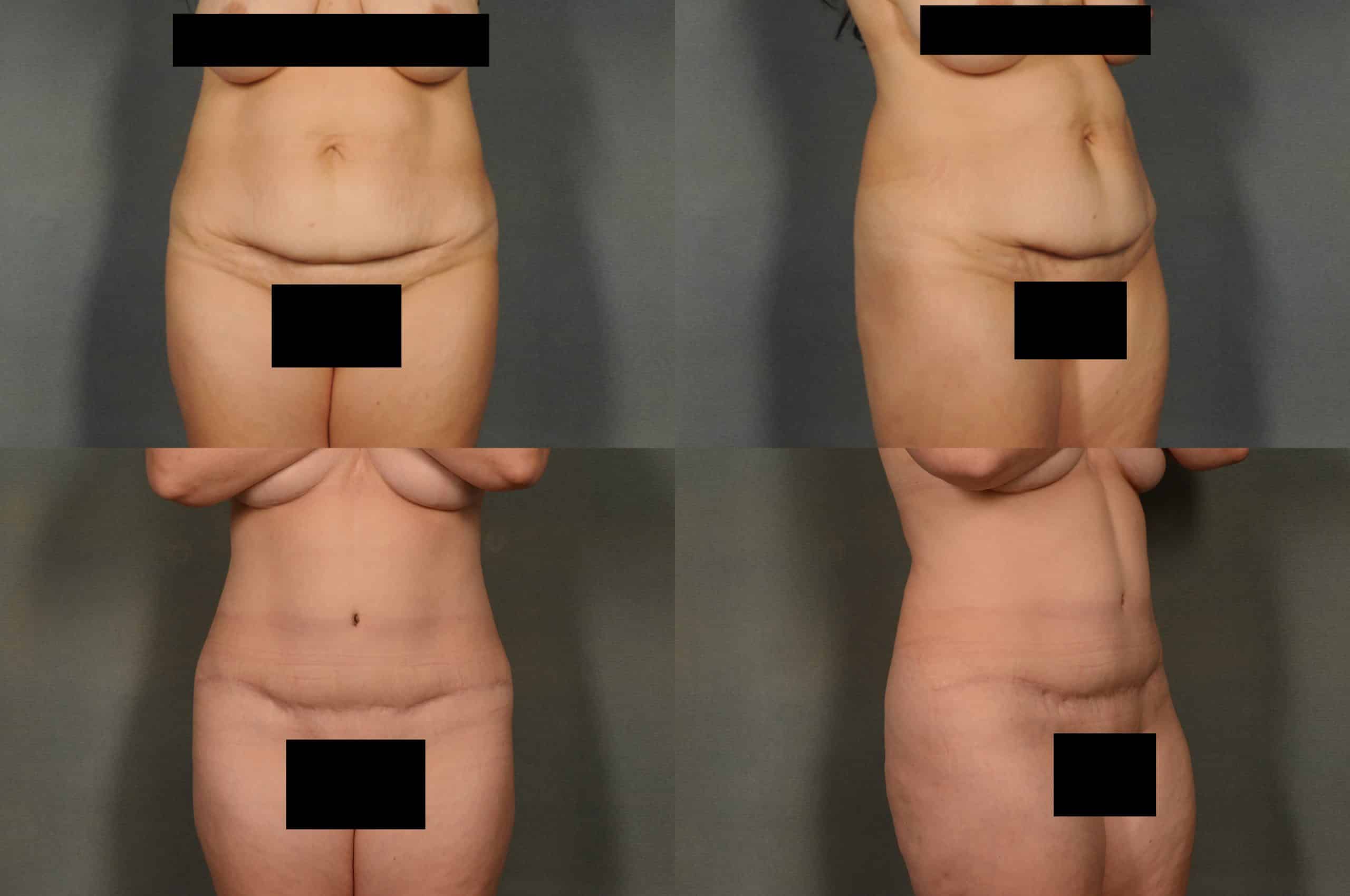 Tummy Tuck Case 919 Combined Image