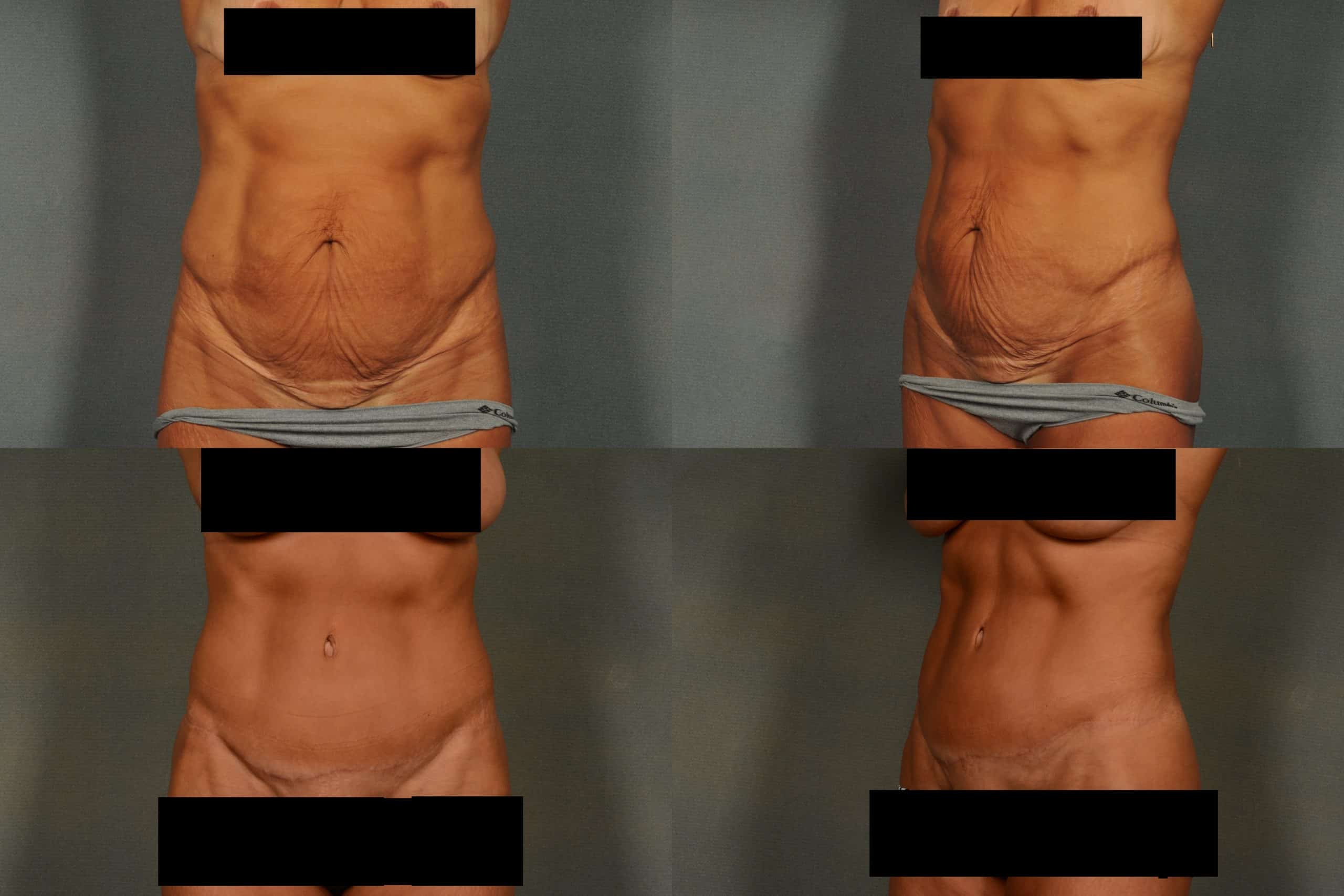 Tummy Tuck Case# 923 Combined Image
