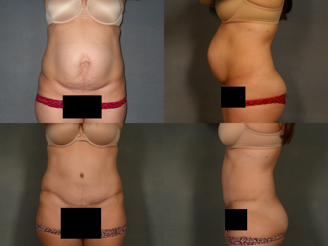 Tummy Tuck Case# 927 Combined Image