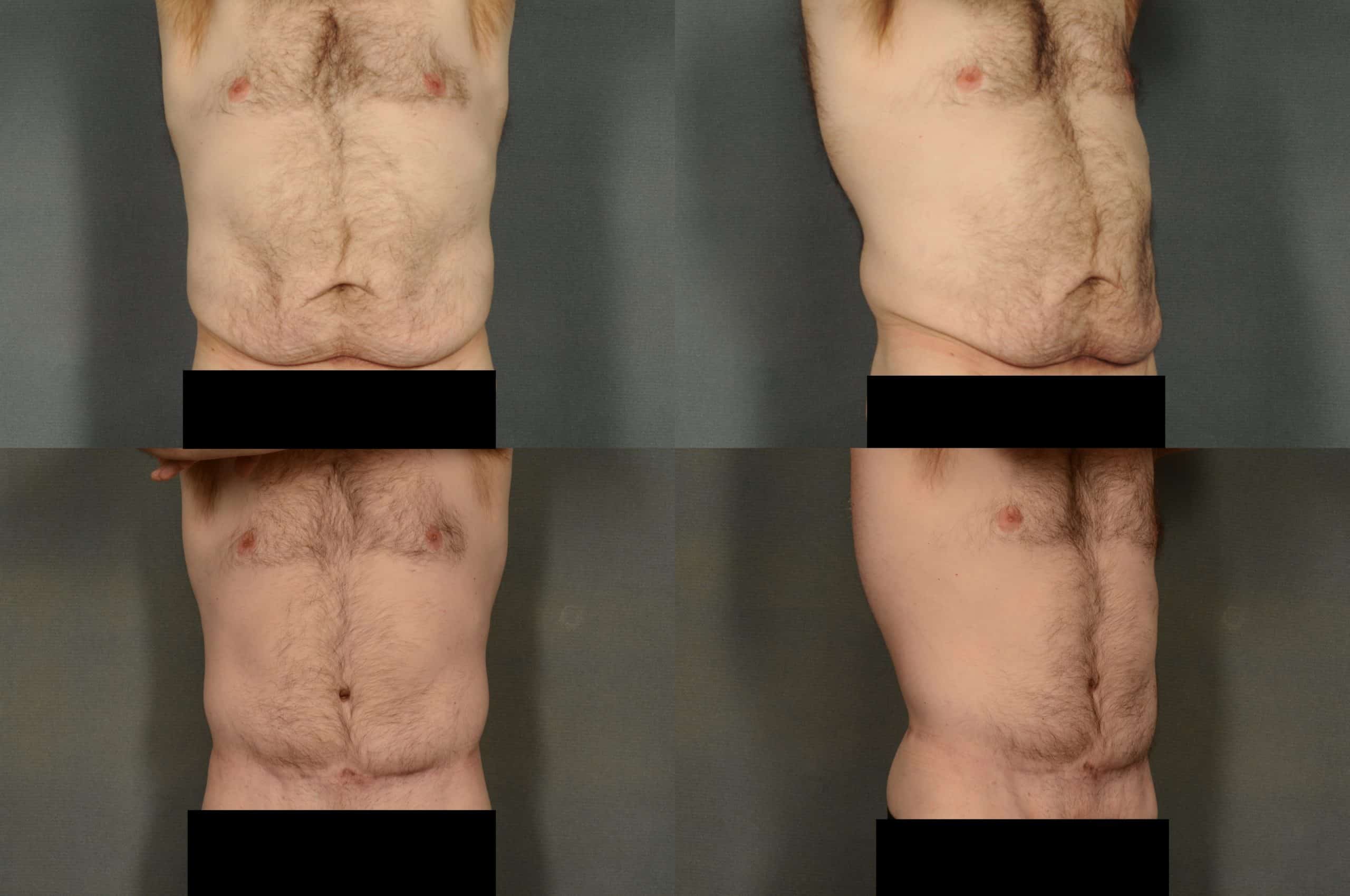 Tummy Tuck Case# 928 Combined Image