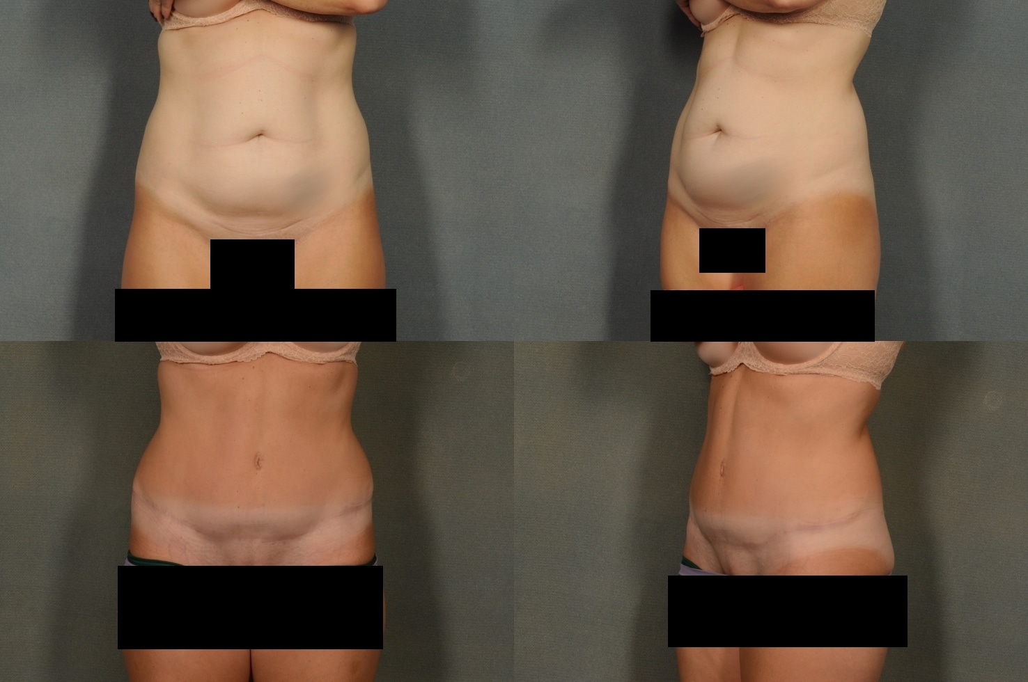 Tummy Tuck Case# 929 Combined Image