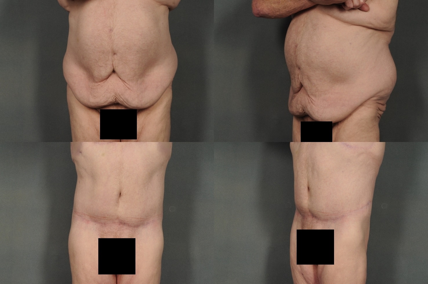 Tummy Tuck Case# 936 Combined Image