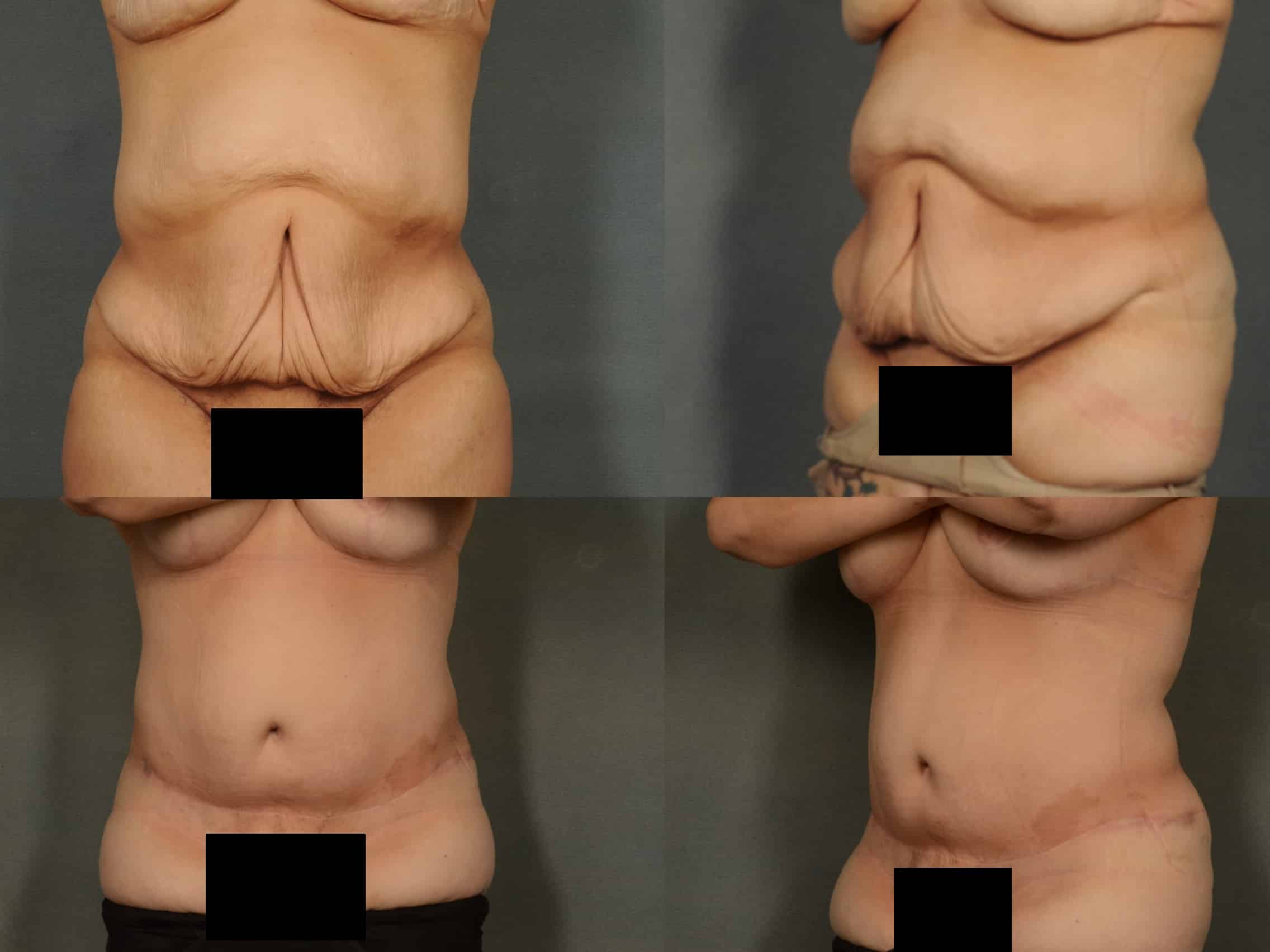 Tummy Tuck Case# 940 Combined Image