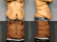 Tummy Tuck Case #941 Combined Image