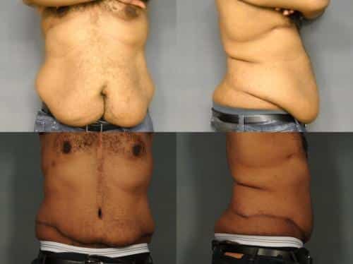 Tummy Tuck Case #941 Combined Image
