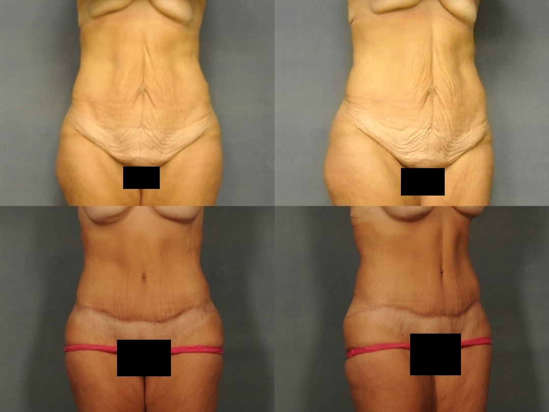 Tummy Tuck Case #942 Combined Image
