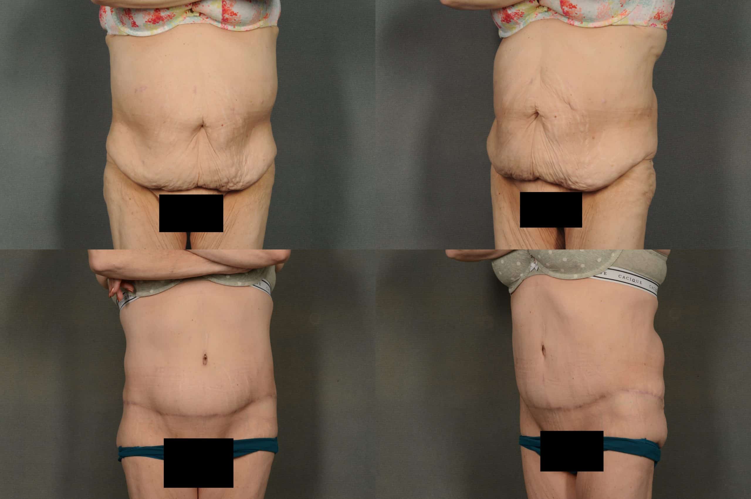 Tummy Tuck Case# 953 Combined Image