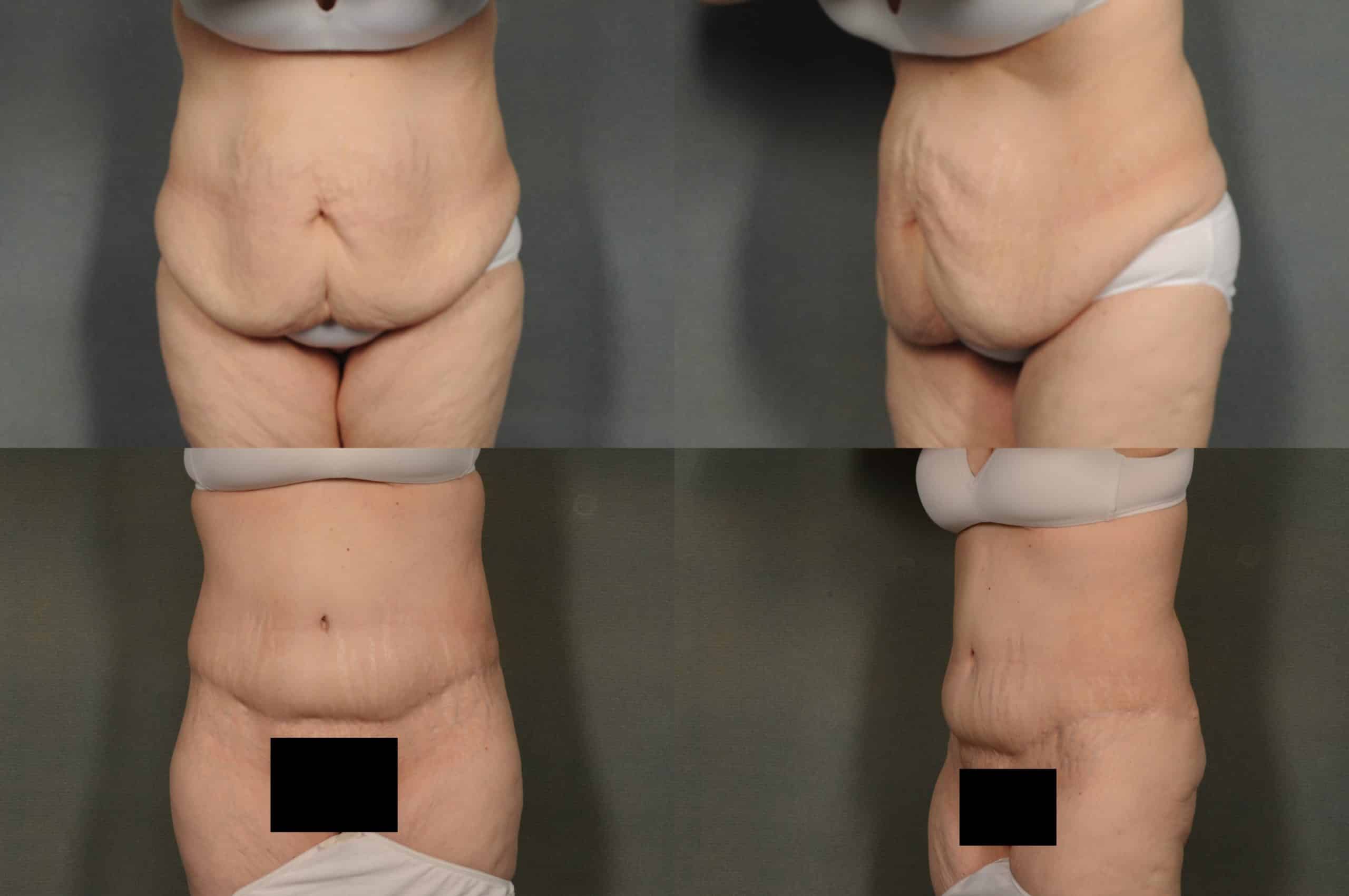 Tummy Tuck Case# 958 Combined Image