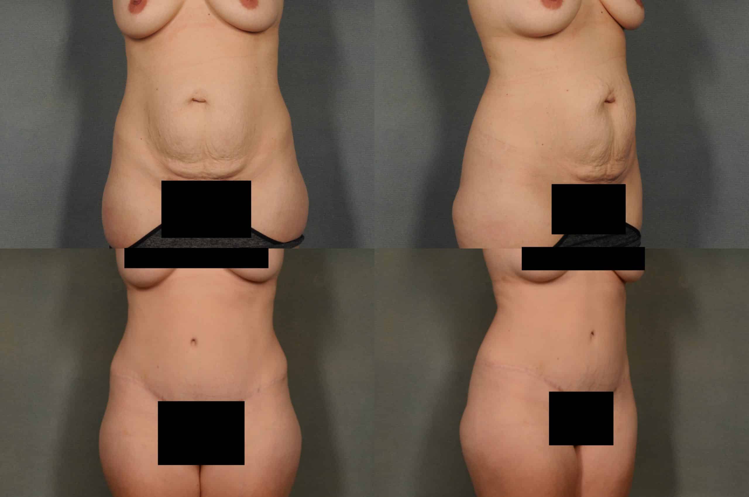 Tummy Tuck Case# 961 Combined Image