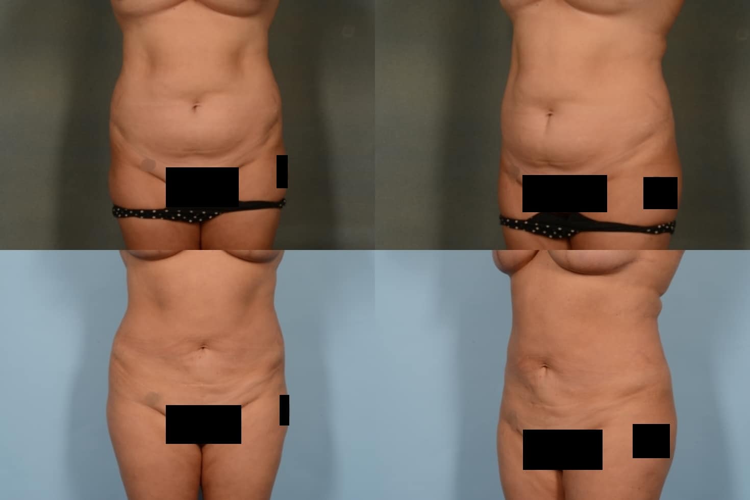 Liposuction Case# 1064 Combined Image