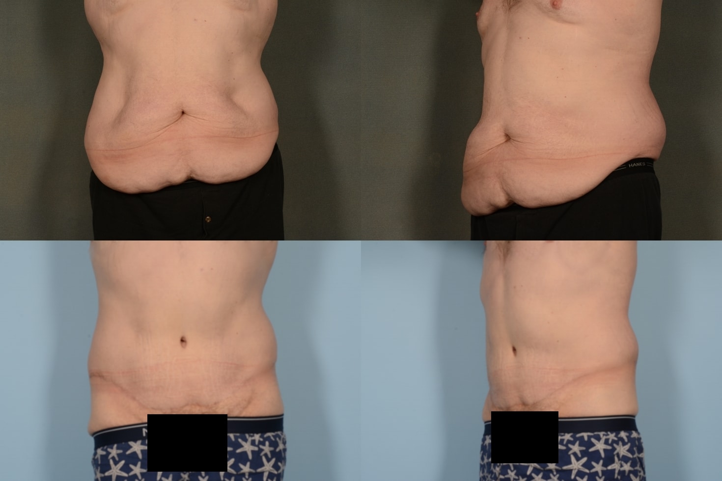 Tummy Tuck Case# 1094 Combined Image