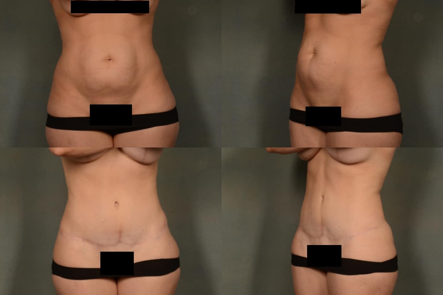 Tummy Tuck Case# 990 Combined Image