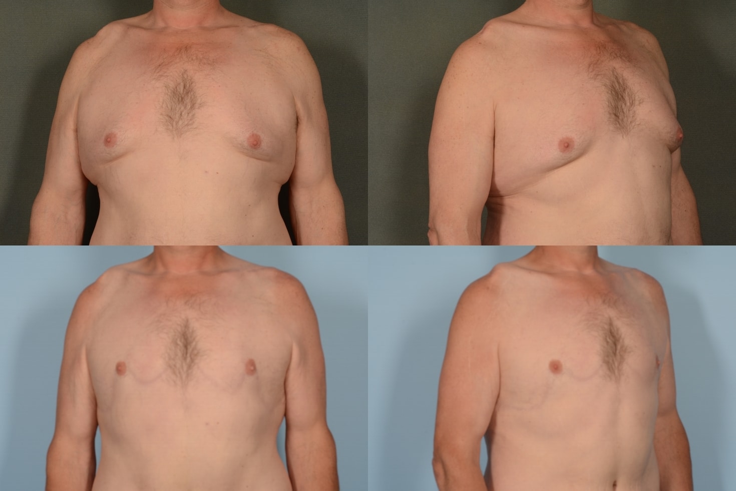 Male Breast Reduction Case# 1093 Combined Image