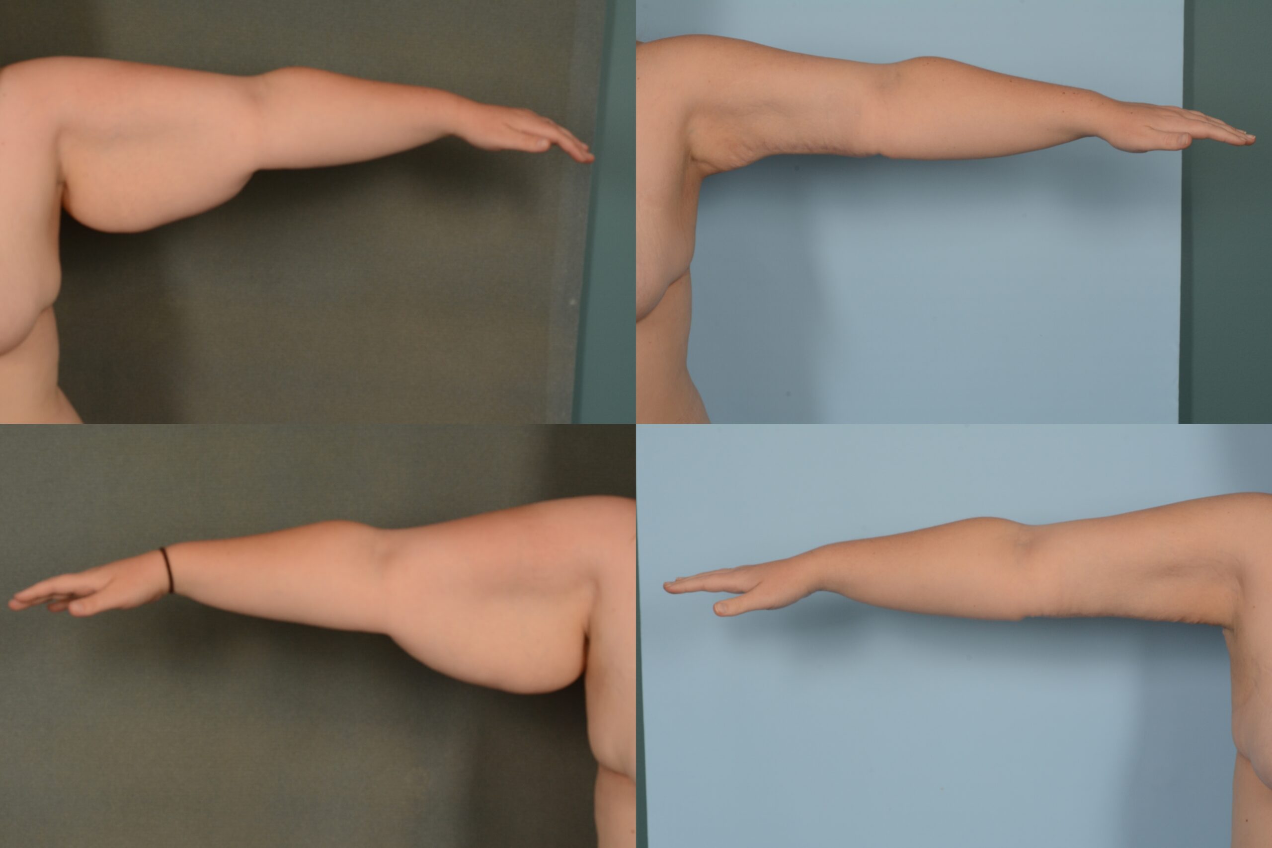 Arm Lift Case# 1092 Combined Image