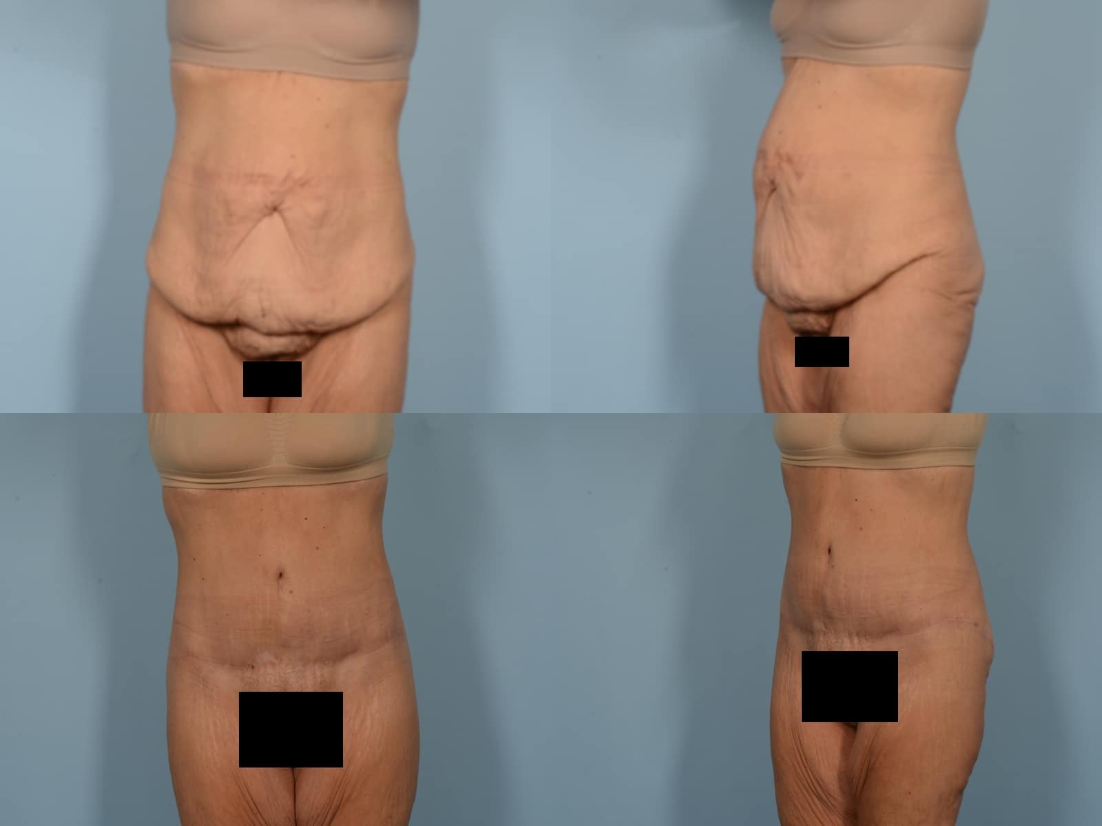 Tummy Tuck Case# 1188 Combined Image