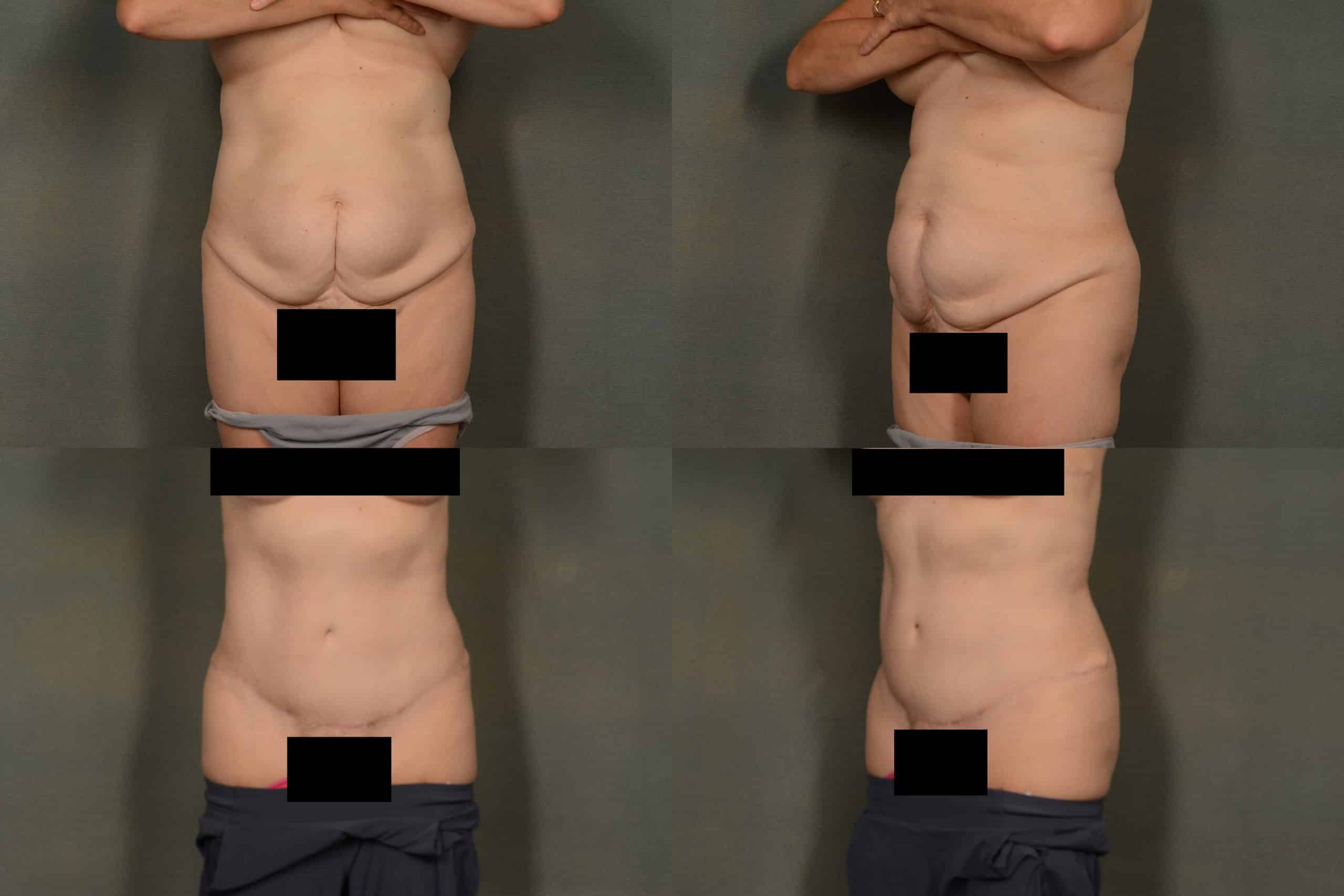 Tummy Tuck Case# 991 Combined Image