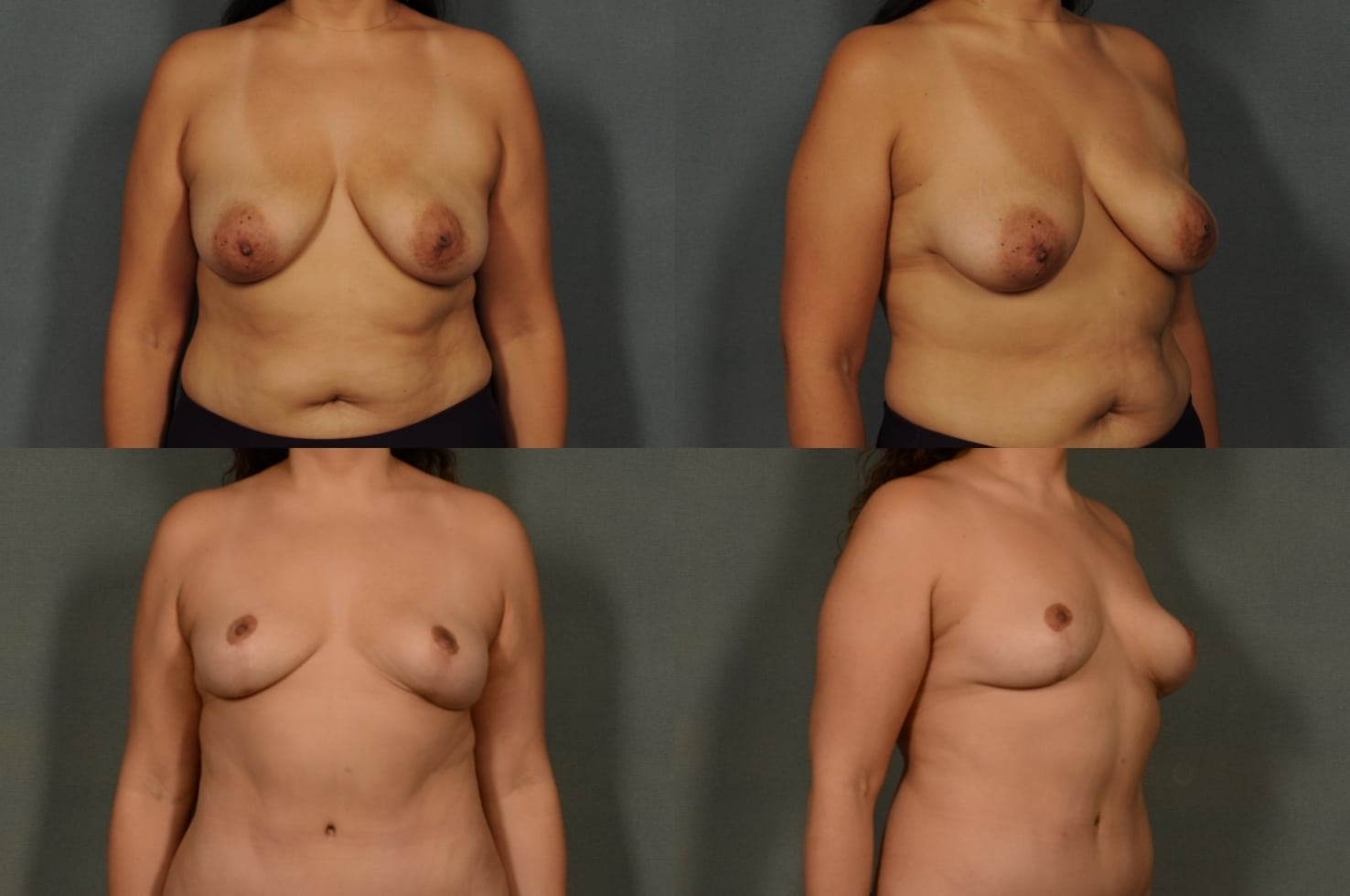Breast Lift Case# 992 Combined Image