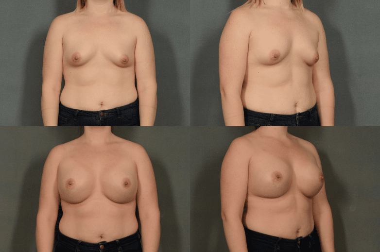 Breast Augmentation Combined Image