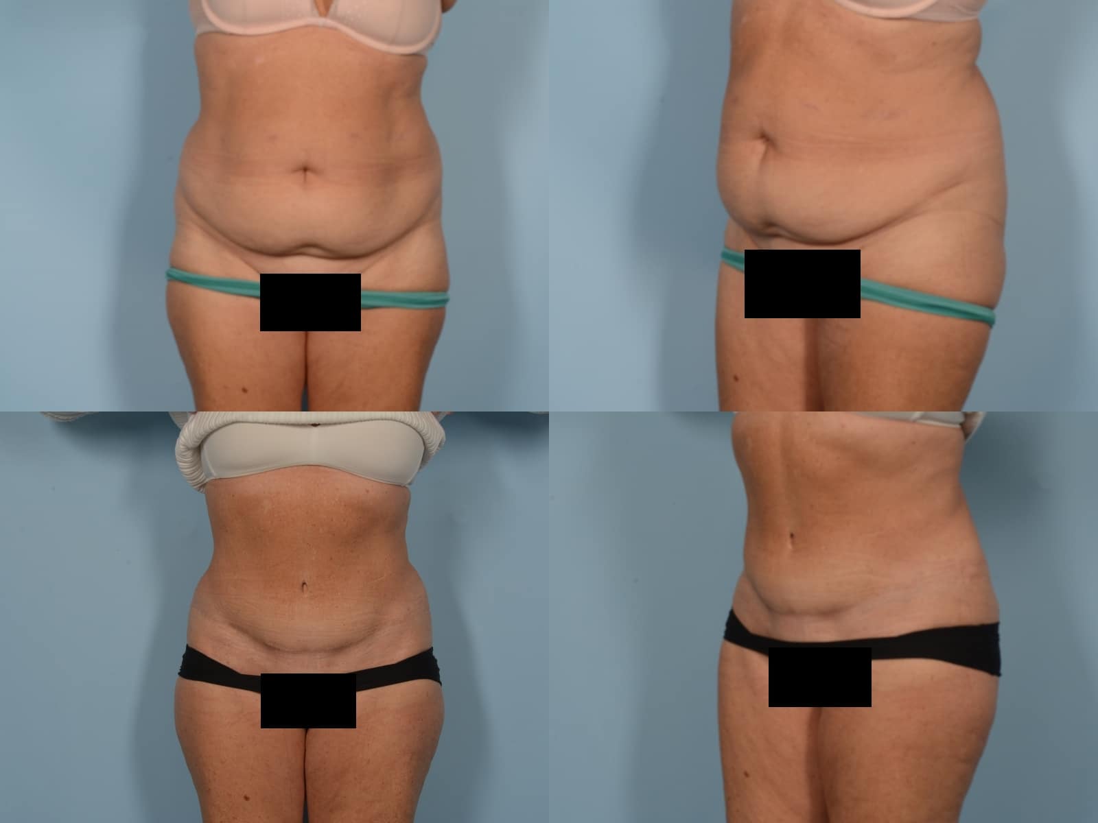 Tummy Tuck Case# 1189 Combined Image