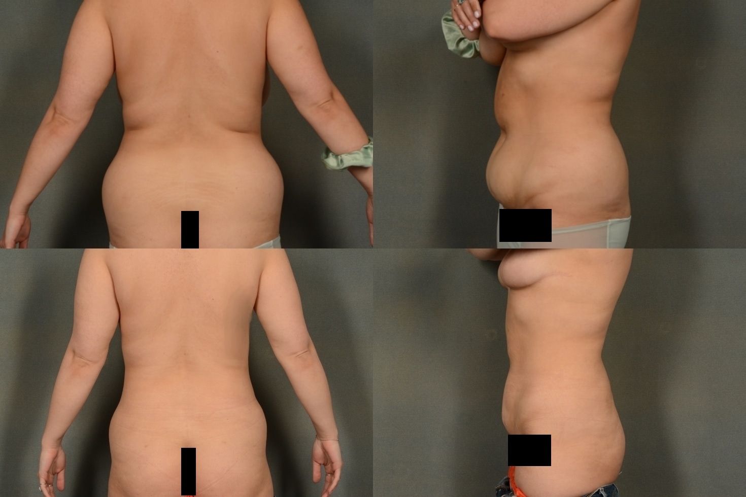 Liposuction Case# 989 Combined Image