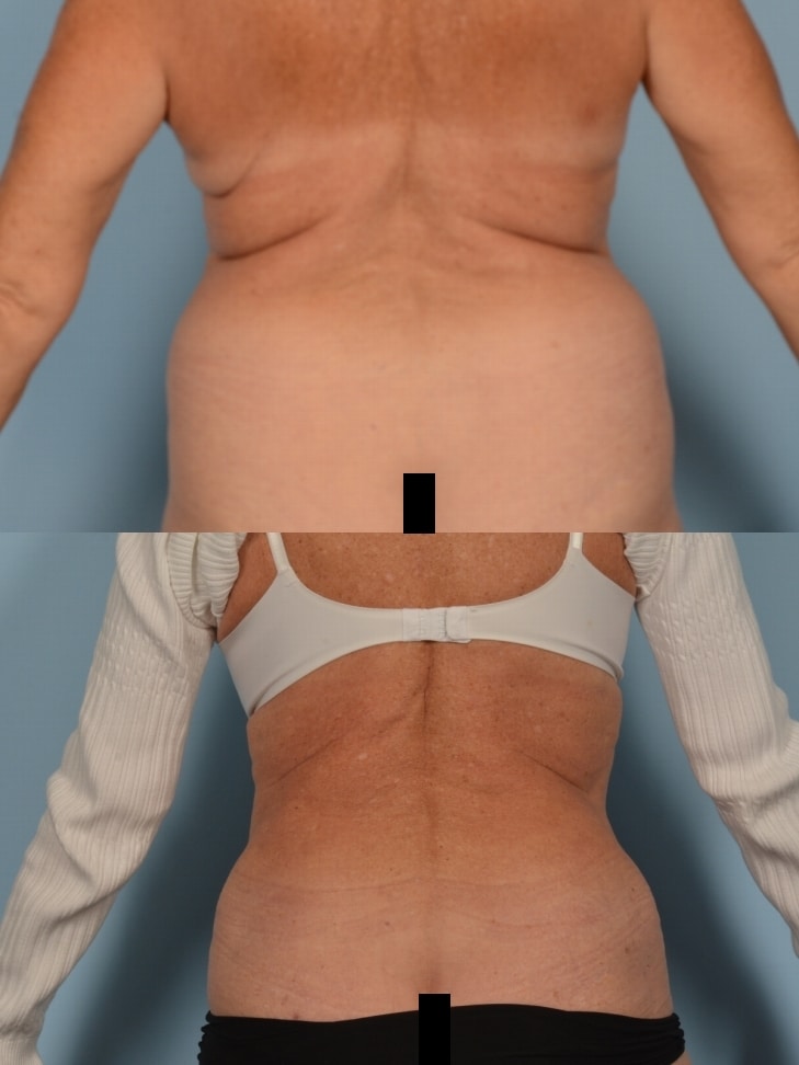 Liposuction Case# 1190 Combined Image